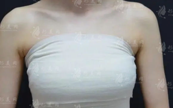 假體隆胸壽命有多久？失敗有什么表現(xiàn)？