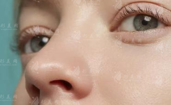 耳軟骨隆鼻尖恢復(fù)時(shí)間一般是多久?怎么護(hù)理能縮短喃?