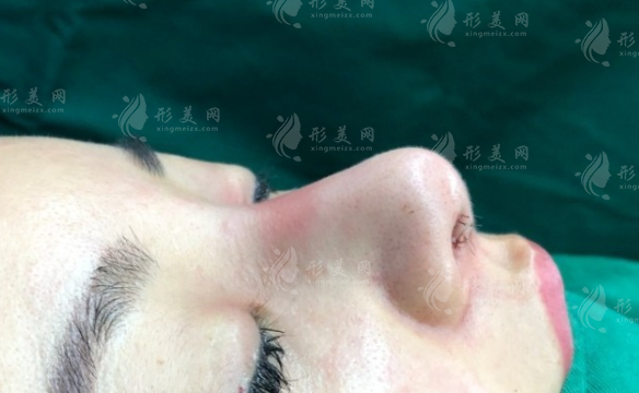 鼻中隔隆鼻的后遺癥有哪些?可以避免后遺癥嗎?