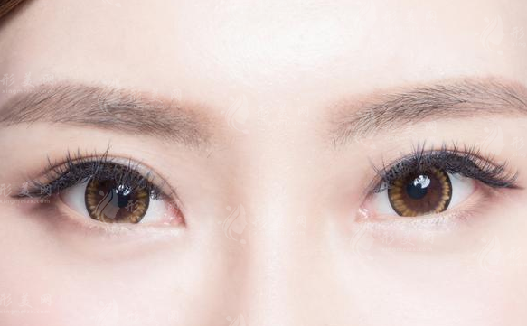做開眼角塑型術(shù)效果能維持多久安?