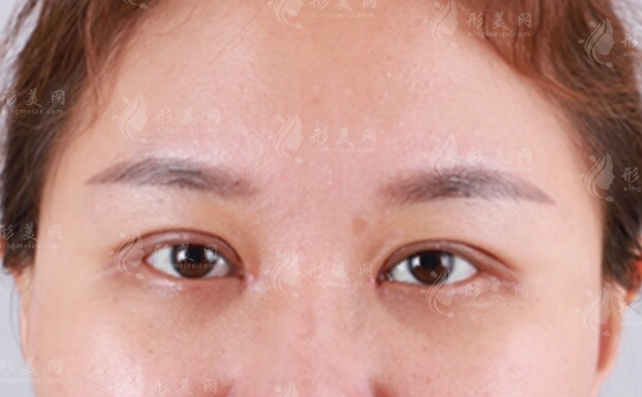 內(nèi)眥贅皮一定要矯正嗎？