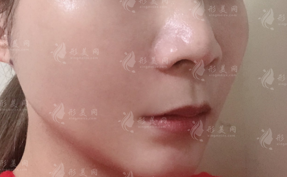 光纖溶脂有副作用嗎?有哪些?