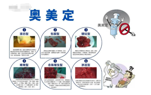 廣州荔灣人民醫(yī)院清奧收費標(biāo)準(zhǔn)，齊云香-林彪斌清奧技術(shù)好！