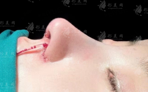 耳軟骨墊鼻梁維持多久時間？
