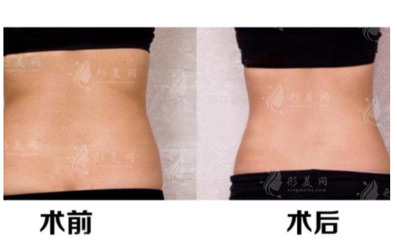 腰部共振吸脂有哪些注意事項(xiàng)？