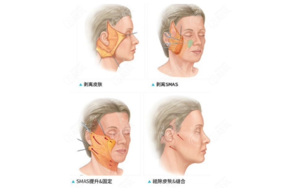 趙延峰拉皮手術(shù)怎么樣？