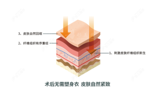 曹孟君治療富貴包怎么樣？土麥森吸脂技術(shù)可從根本解決問題