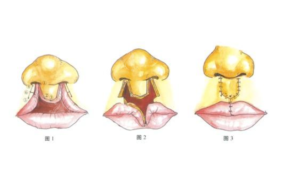 上海九院做兔唇修復(fù)怎么樣？專家信息、項(xiàng)目介紹、價格表