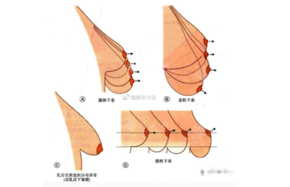 乳房下垂矯正