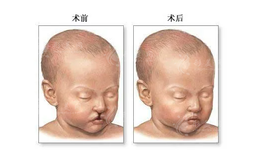 上海第九整形美容醫(yī)院唇腭裂修復(fù)價(jià)格