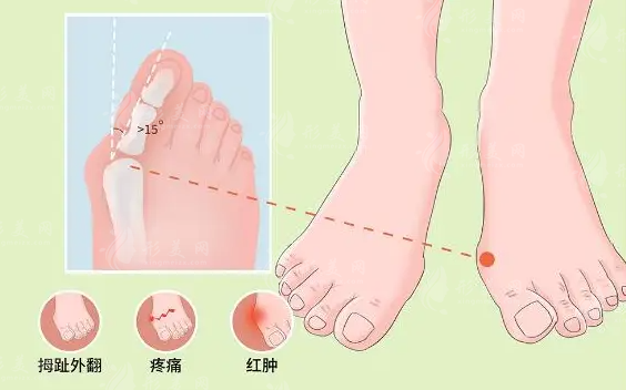 拇外翻手術