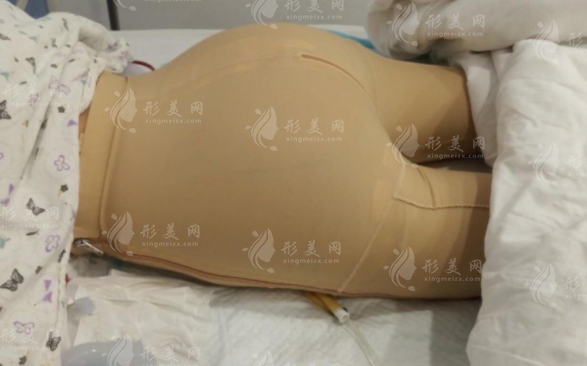 假體豐臀術后多久可以坐著?恢復時間、價格及后遺癥提前了解