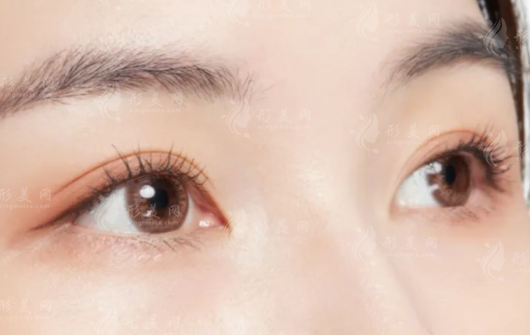 無(wú)痕雙眼皮怎么做出來(lái)的？維持時(shí)間,多久恢復(fù)和價(jià)格參考