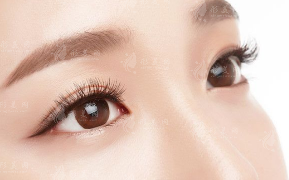內(nèi)眥贅皮一定要開眼角嗎?
