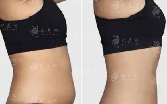 吸脂減肥塑身衣：何時(shí)穿戴，術(shù)后注意事項(xiàng)