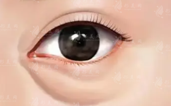 下眼袋去除術(shù)恢復(fù)期，及日常防止眼袋增大策略