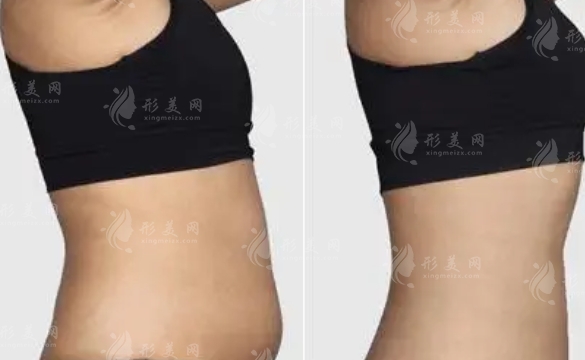 腰腹部吸脂手術(shù)：好處與壞處，價(jià)格分析