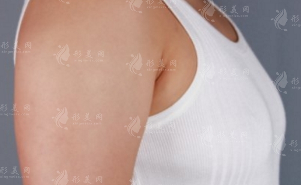 硅膠隆胸取出后可以用脂肪填充嗎？術(shù)后注意事項詳解