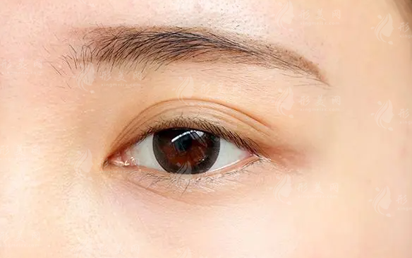 如何去除眼角細(xì)紋：手術(shù)與非手術(shù)方法的比較