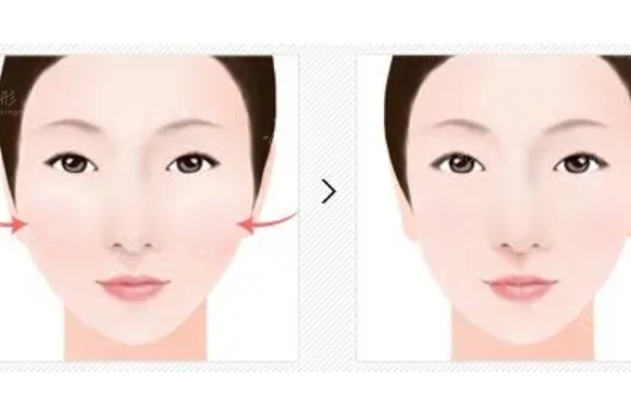 顴骨降低和顴骨內(nèi)推的區(qū)別是什么？手術(shù)后注意哪些事情？