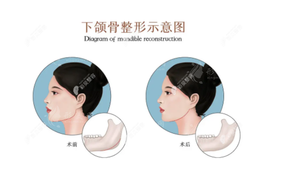 成都磨骨手術(shù)專家盤點：擁有四級手術(shù)資質(zhì)的精英醫(yī)生