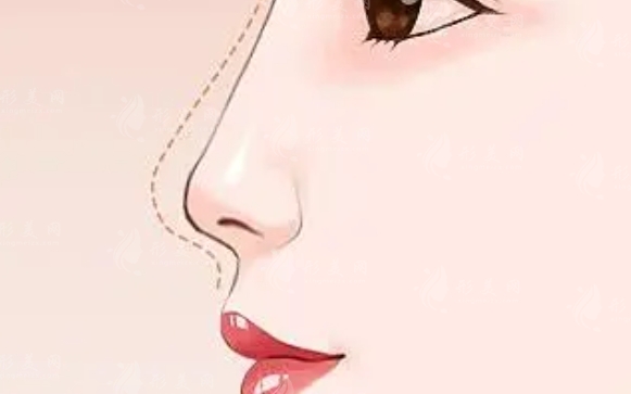 硅膠假體隆鼻價(jià)格探討:價(jià)格區(qū)間及影響因素分析 硅膠假體隆鼻價(jià)格探討:價(jià)格區(qū)間及影響因素分析