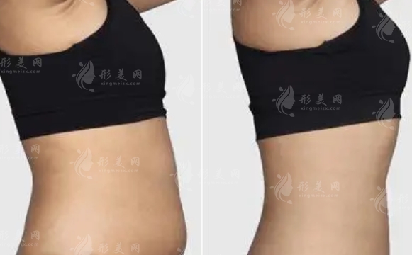 360度吸脂需要多少錢(qián)?手術(shù)有哪些風(fēng)險(xiǎn)呢?