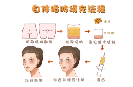 揭秘八大處李發(fā)成脂肪填充：精湛技藝與價(jià)格透明度解析
