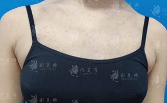 副乳切除術(shù)的優(yōu)點與并發(fā)癥分析