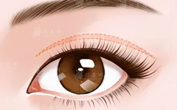 上海時光整形雙眼皮多少錢？手術(shù)醫(yī)生介紹、案例分享、附價格
