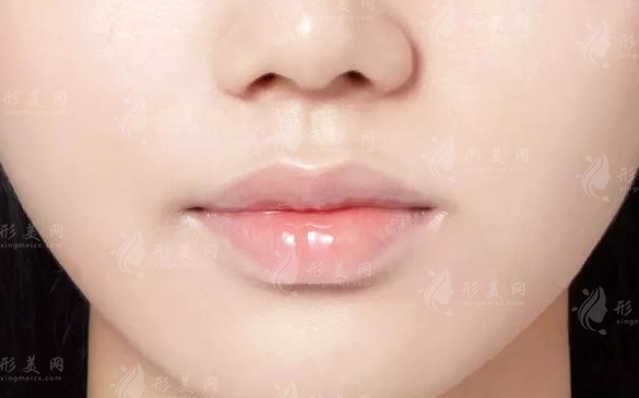 唇部提升手術(shù)：解析與適用人群探討