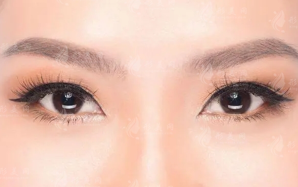 影響開內(nèi)眼角拆線時間的因素探究