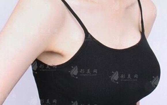 副乳切除后多長時(shí)間才能恢復(fù)正常?