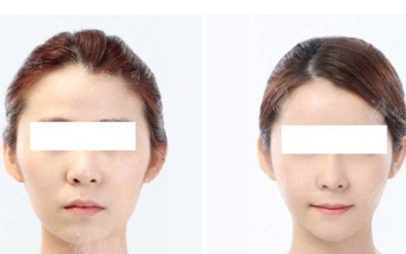 顴骨不好看怎么辦？削顴骨手術效果及維持時間解析