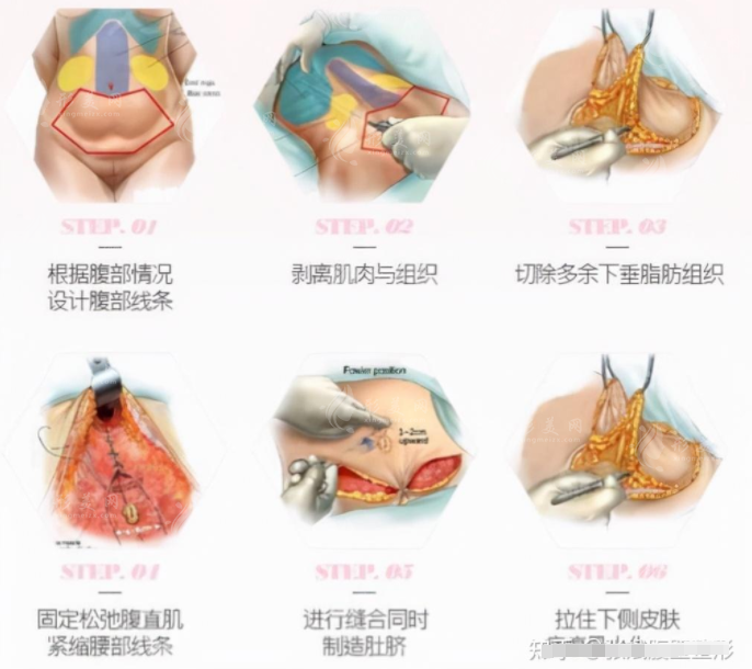 腹壁成形