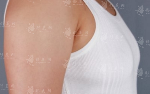 硅膠隆胸：美麗與哺乳的雙重考量