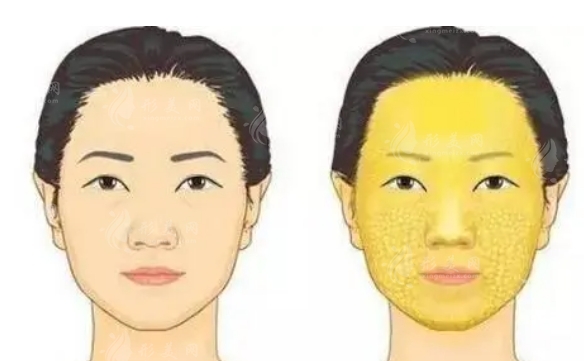 為什么填充自體脂肪后不能立即沾水？