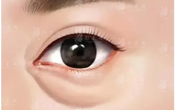 影響去眼袋效果維持時(shí)間的因素