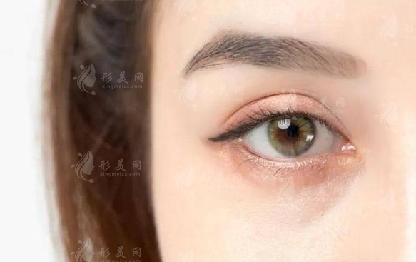 自體脂肪填充眼窩的安全性及手術次數解析