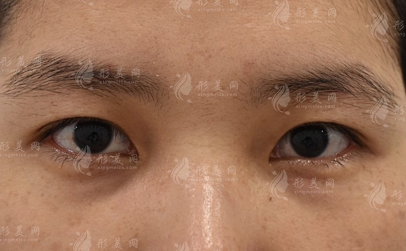影響自體脂肪填充淚溝維持時間的因素分析