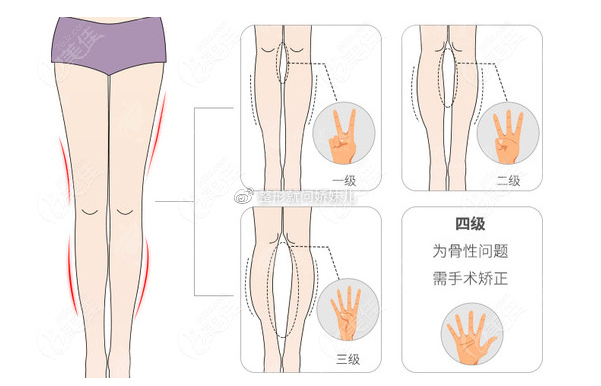 北京櫻桃醫(yī)療美容腿部吸脂怎么樣？做腿部吸脂/直腿術(shù)很可靠