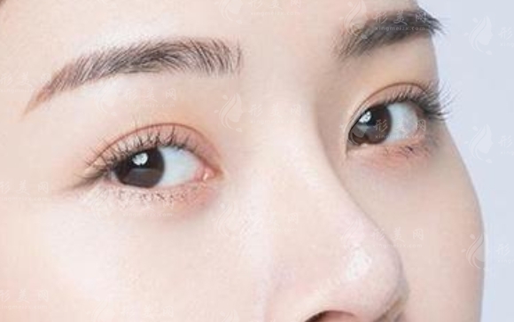 開眼角術(shù)后疤痕的修復(fù)之路