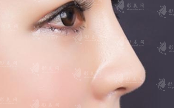 鼻尖縮小術后增生原因及預防策略