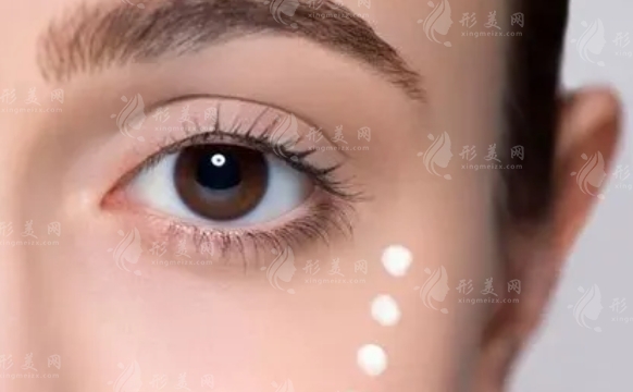埋線雙眼皮手術:了解其后遺癥與風險 埋線雙眼皮手術:了解其后遺癥與風險