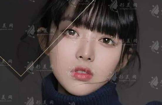 雙眼皮案例