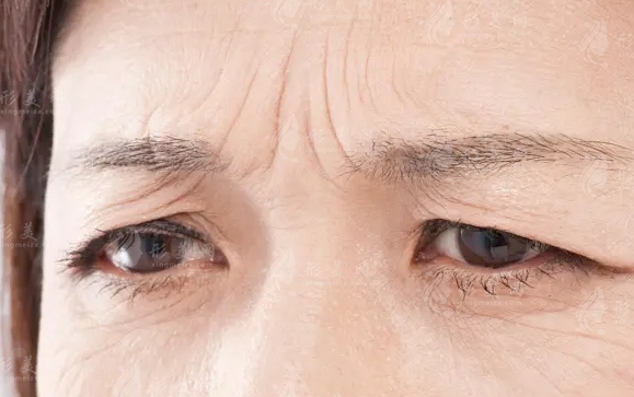 眉間皺紋的常見(jiàn)類型及去除方法