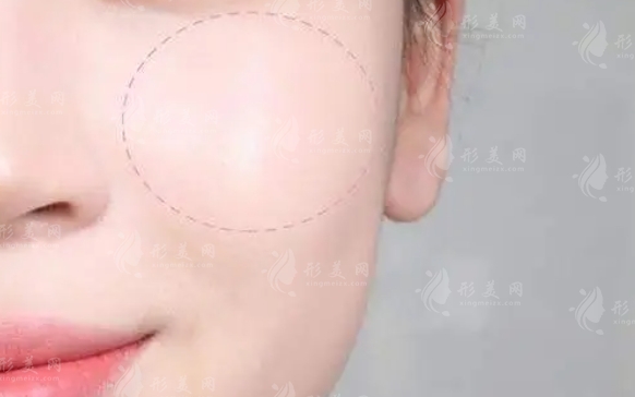 自體脂肪豐蘋果?。鹤匀?、安全且效果顯著