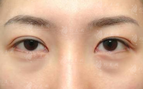 假性眼袋與真性眼袋：辨識(shí)與改善策略
