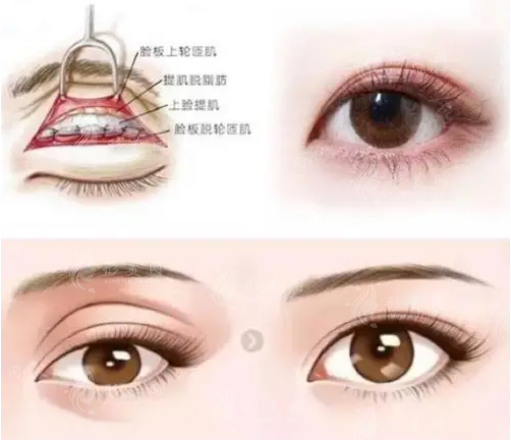杜園園和張冰潔雙眼皮修復(fù)哪個(gè)做得好？技術(shù)水平/風(fēng)格/收費(fèi)價(jià)格