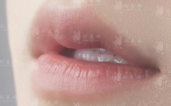 唇珠：適合所有人的美學(xué)密碼，還是因人而異的魅力點(diǎn)綴？